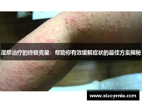 湿疹治疗的终极克星：帮助你有效缓解症状的最佳方案揭秘
